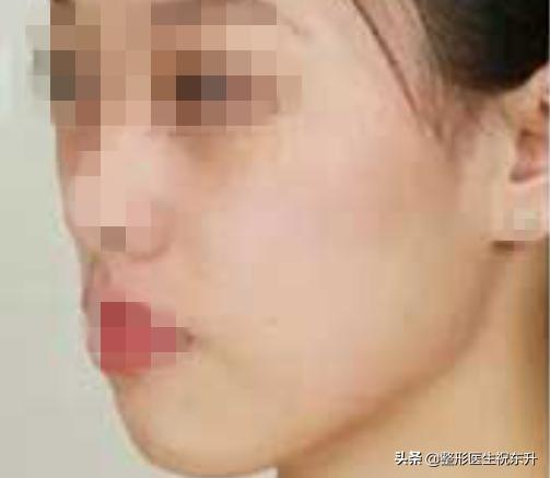 脸部凹陷怎么变饱满面部填充,脸凹陷全脸填充会不好看吗