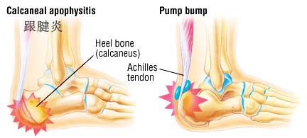 跑步足跟痛的原因及治疗方法,产后足跟痛是什么原因引起的