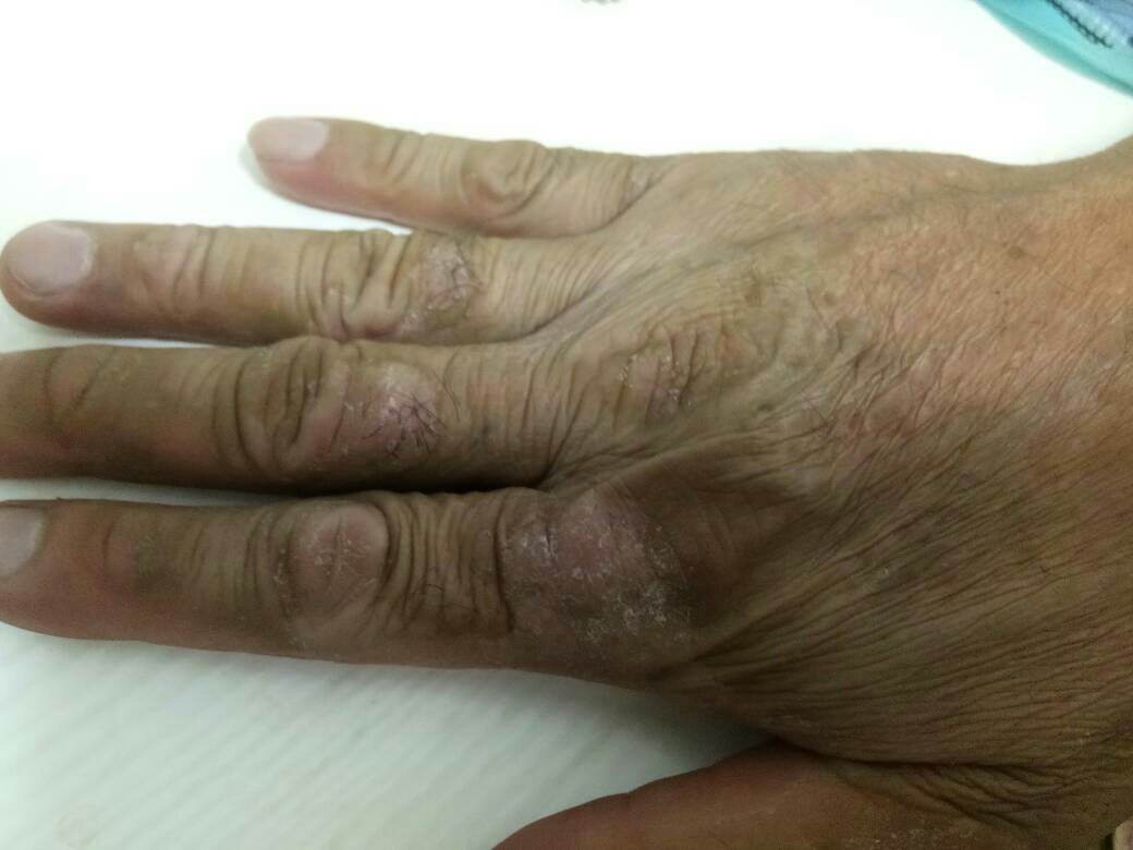 我亲身经历的中老年皮肤瘙痒、湿疹治疗故事