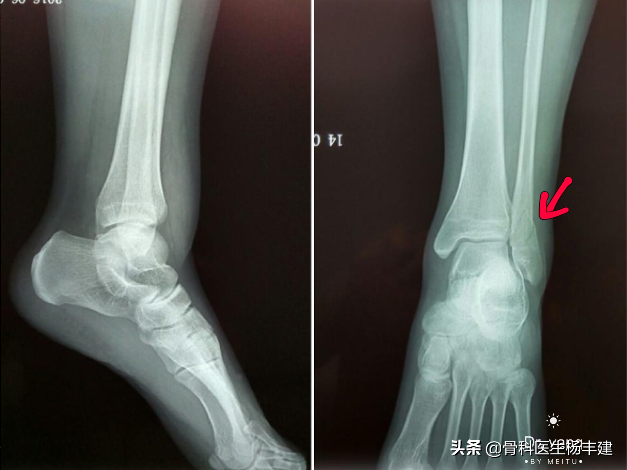 什么样的脚踝骨折适合保守治疗,什么样的腿骨骨折需要手术