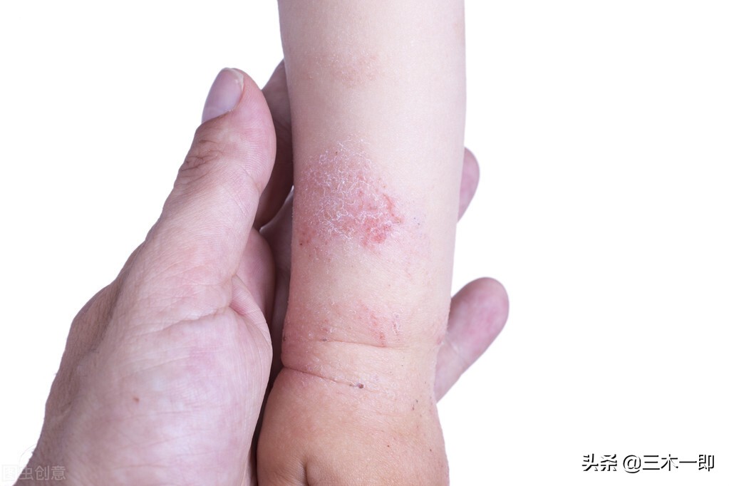 湿疹怎样做好日常预防护理,儿童湿疹反复发作三招教你搞定
