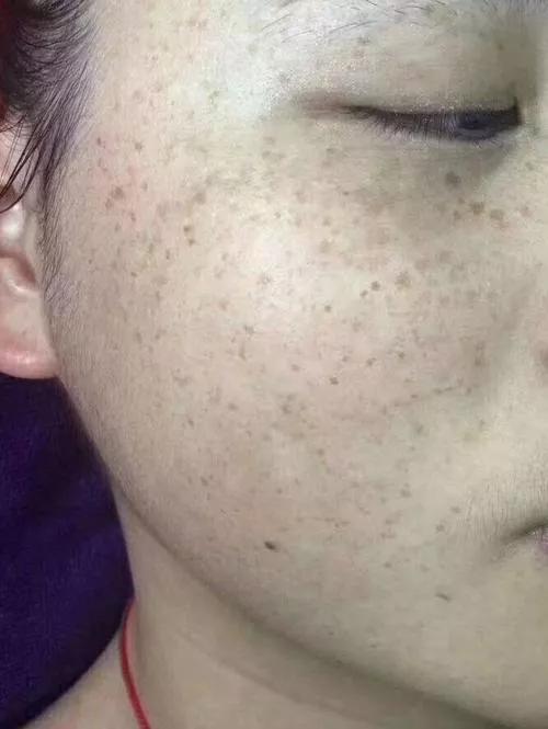 祛斑骗局揭秘,女子祛斑15分钟花了3万