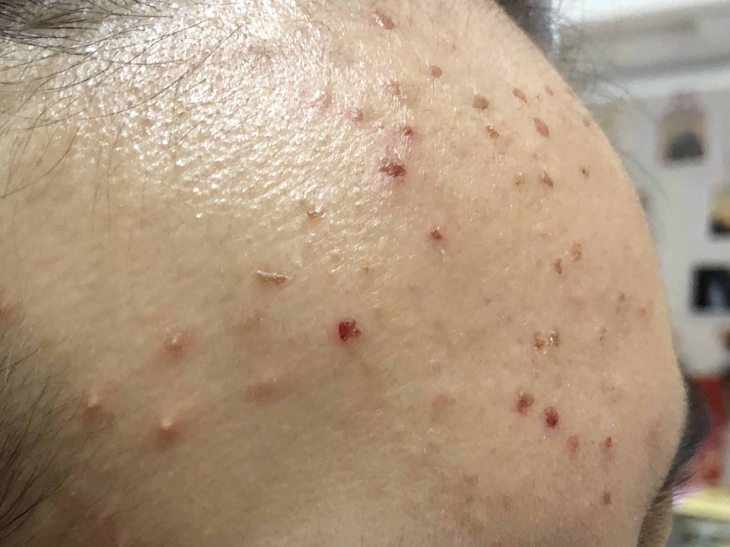 17岁的孩子身上脸上长了好多痘痘,17岁女孩脸上长好多痘痘怎么办