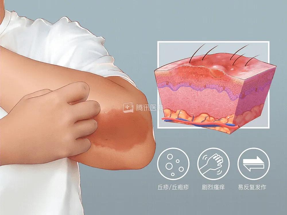 得湿疹了自己会好吗,得了湿疹要忌什么