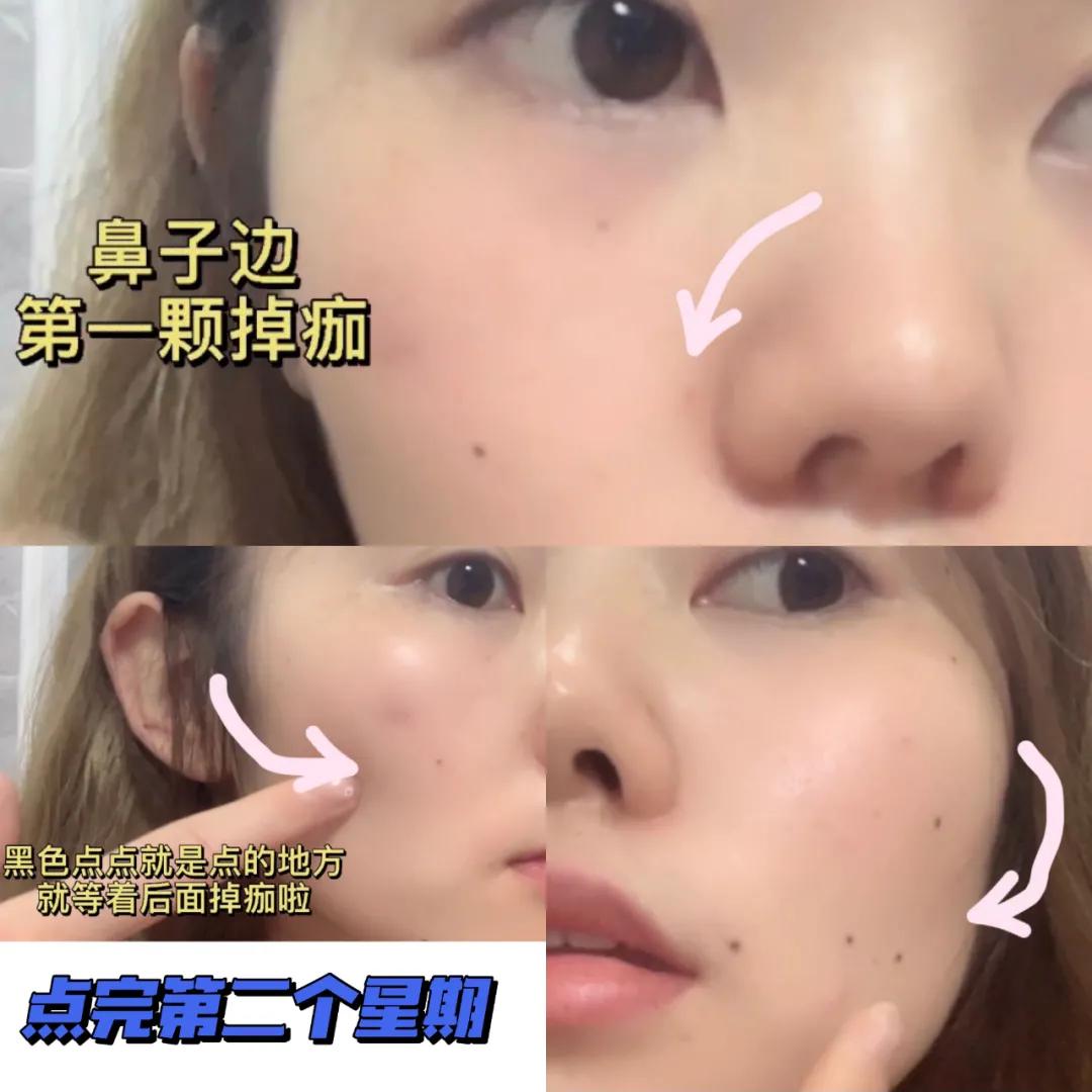 药水点痣一星期了还忌口吗,药水点痣后续护理