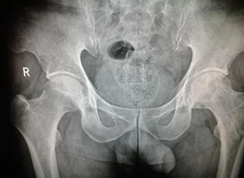 股骨头坏死二三期康复锻炼姿势,二三期股骨头坏死保髋成功率高吗