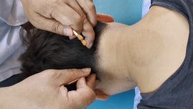 头晕颈椎病的最好治疗方法,针灸推拿拔罐能治疗颈椎病吗