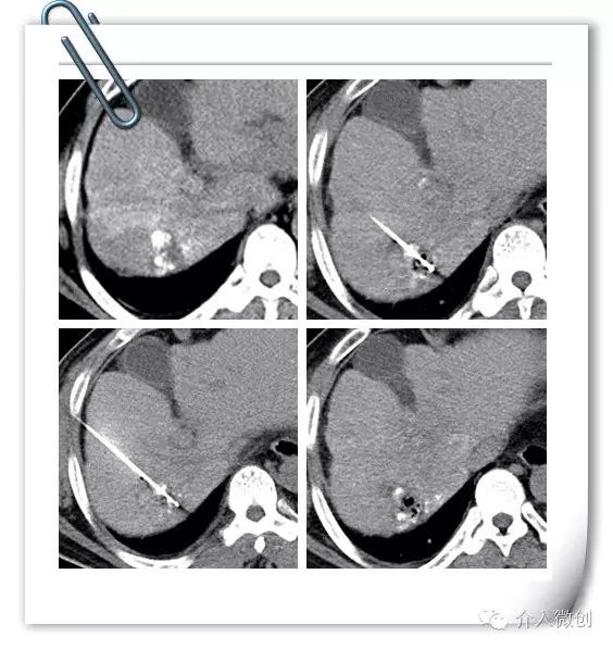 肝癌门静脉癌栓能做介入手术吗,肝癌门静脉癌栓中医治疗
