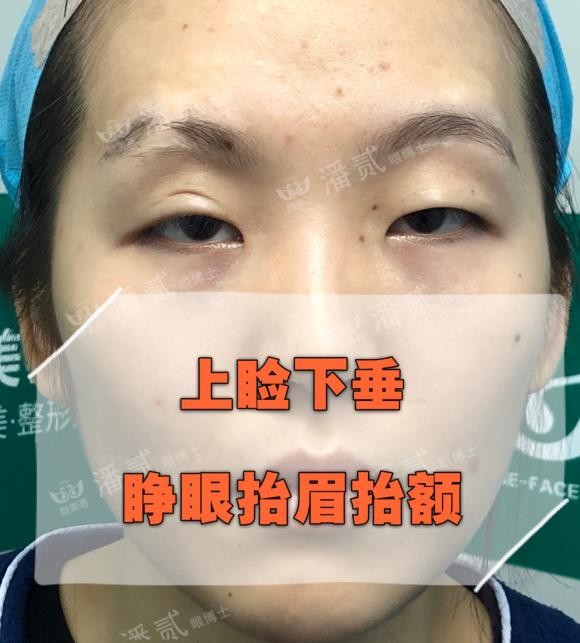 双眼皮离眉毛太近还能修复好吗,割双眼皮眉毛下面肿会消肿吗