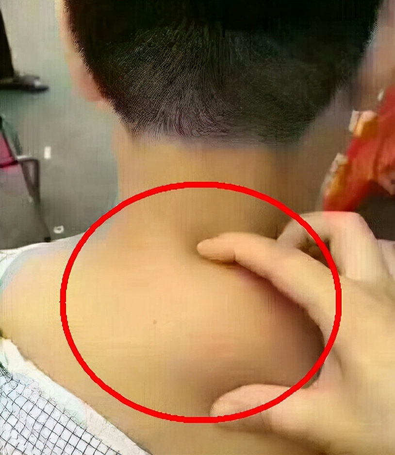 负压吸脂和射频吸脂,光纤溶脂和负压吸脂优缺点