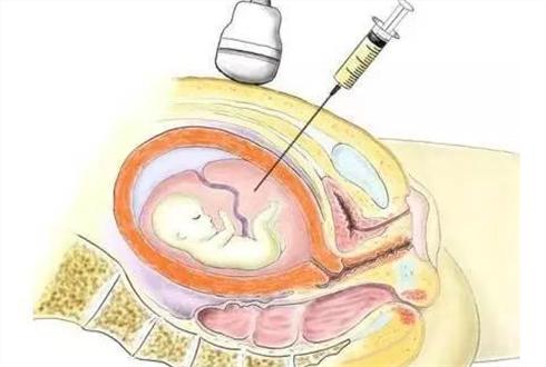 妇产科医生：什么是羊水穿刺？哪些孕妈妈需要做这个检查？