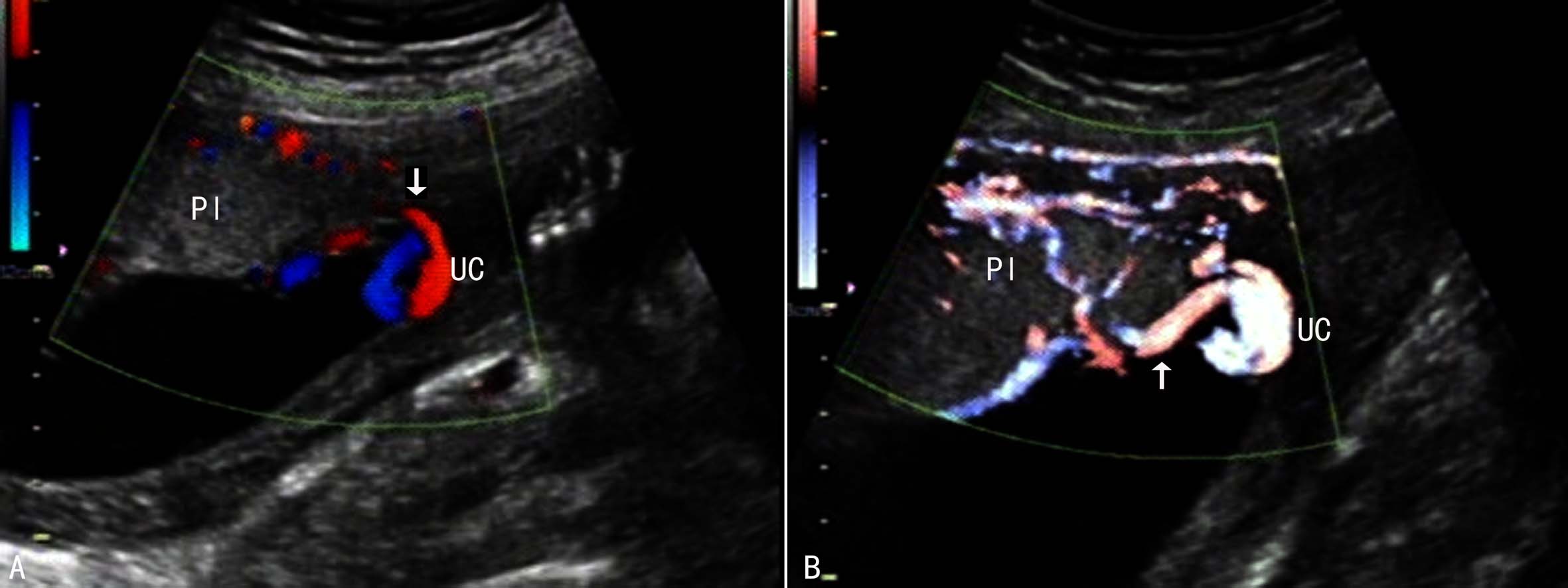 做彩超可以看出来脐带多长吗,超声检查脐带绕颈一圈正常吗