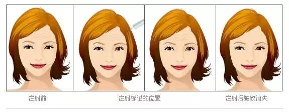 微创面部除皱提升,面部提升除皱多少钱一次