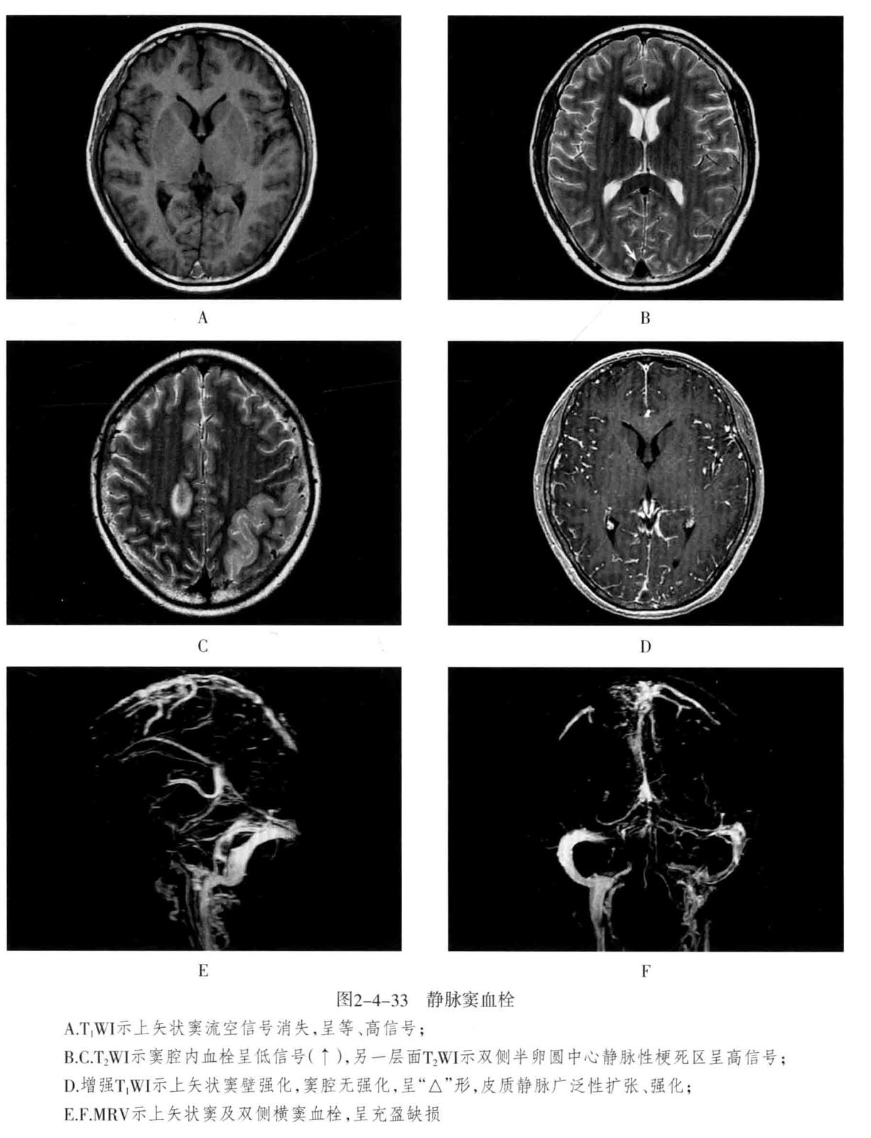颅内血管周围间隙的影像鉴别,颅脑血管源性疾病影像诊断