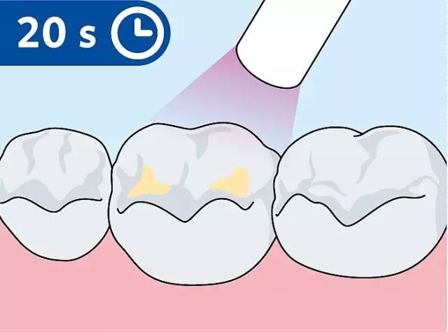 什么是儿童窝沟封闭?会不会痛?1分钟视频带你看懂#雅悦齿科#