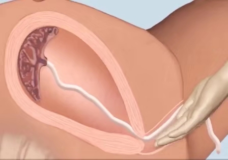 顺产从宫缩到生需要多久,顺产一般需要多长时间