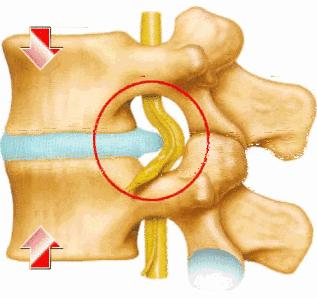 腰椎间盘突出症是怎么回事？一定要手术吗？能做微创治疗吗？