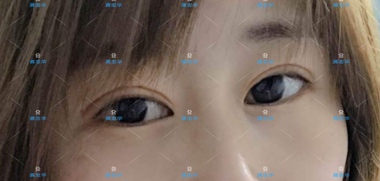 眼皮松弛可以做埋线双眼皮吗,埋线双眼皮眼皮松弛了该怎么办