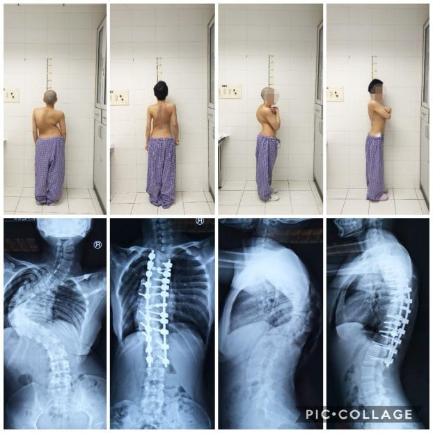 北京青少年脊柱侧弯矫正最佳方法,北京脊柱侧弯校正