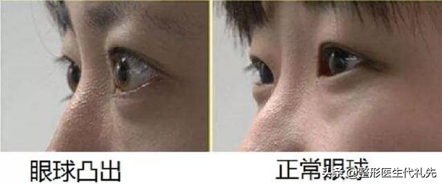 拯救肿泡眼做双眼皮的经历分享,肿眼泡做双眼皮恢复过程经历真实