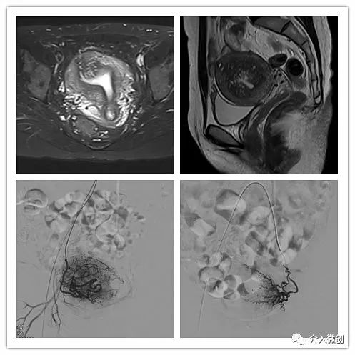 子宫腺肌症「不死的癌症」——介入栓塞来帮忙