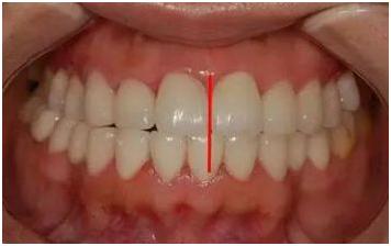 整牙期间怀孕会得牙周炎,怀孕期间能不能牙齿矫正