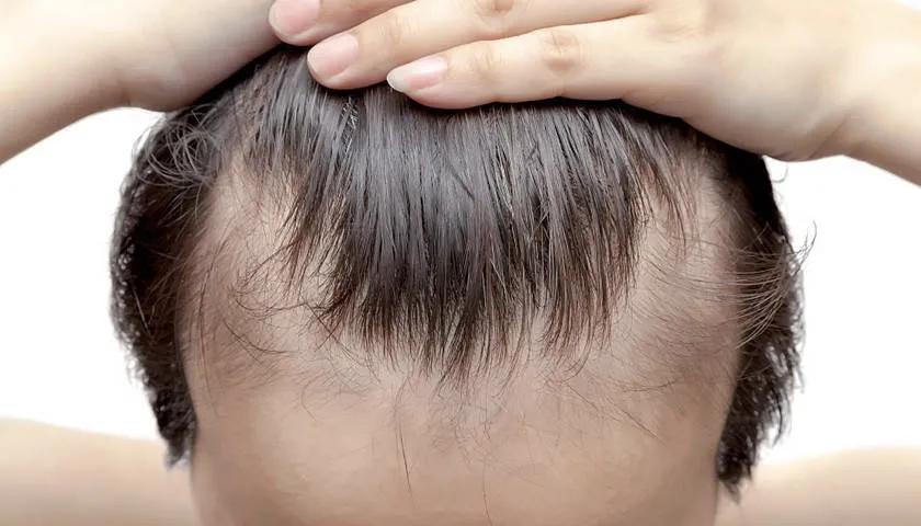 雍禾植发干细胞再生,雍禾植发脂溢性掉发能自己恢复吗