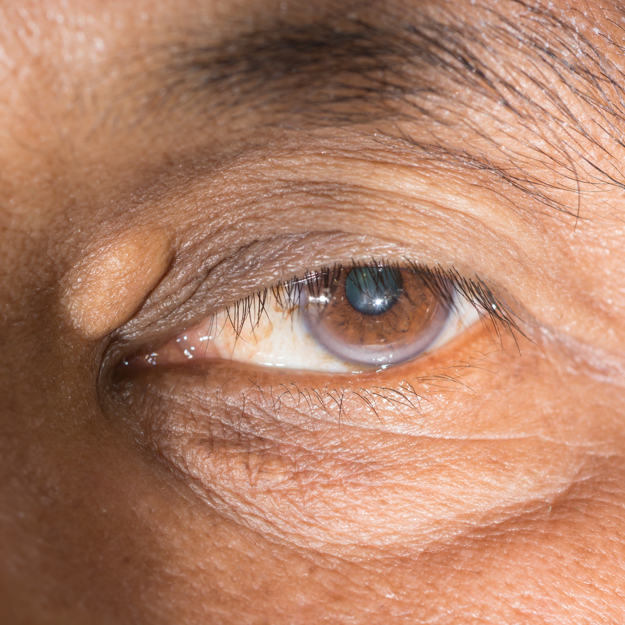 眼周症状有哪些表现,眼周神经炎是什么症状