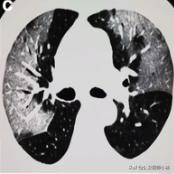 新型冠状病毒肺炎患者的肺,新型冠状病毒患者肺部体征