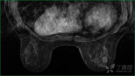乳腺结节有消散的病例吗,一份完整的乳腺增生病例