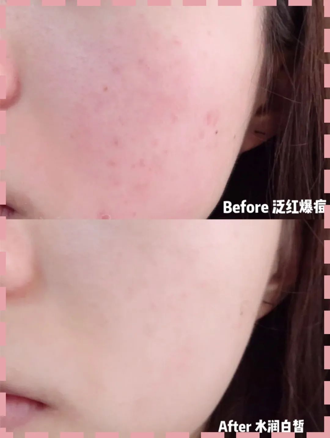 过敏长痘护肤品,一戴口罩脸过敏发痒发红怎么治