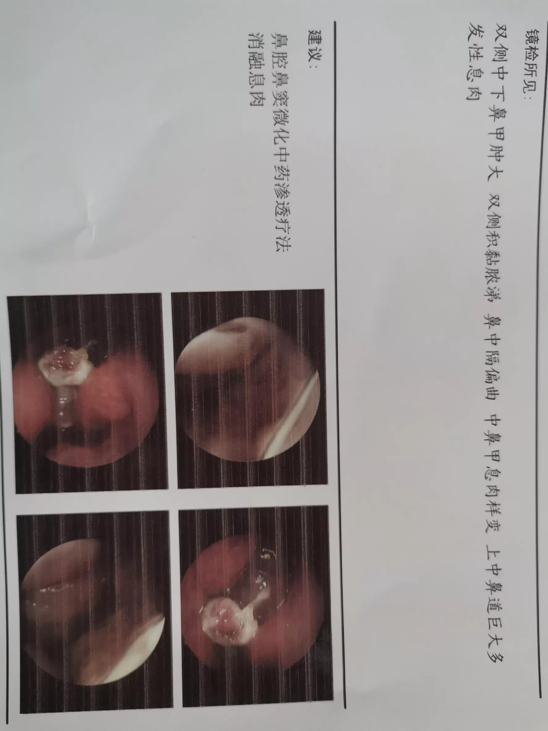 与鼻炎战斗的日子,鼻炎的真实生活日记