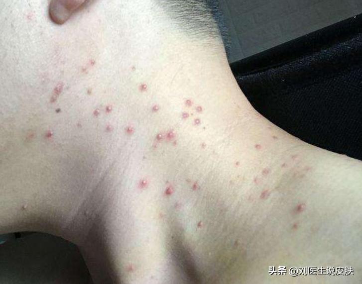 前胸后背长痘毛囊炎,前胸后背痤疮和毛囊炎的药