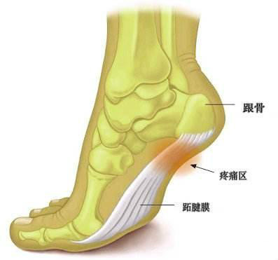 跖筋膜炎和足跟脂肪垫炎,足底筋膜炎怎么缓解疼痛