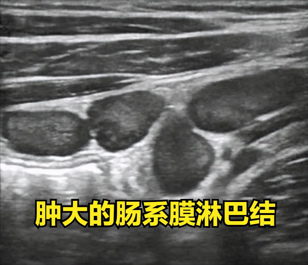 儿童经常淋巴结肿大腹痛,儿童肠系膜淋巴结腹痛是怎么回事