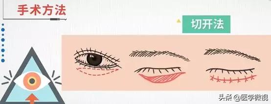 睫毛长倒睫怎么办,睫毛倒长扎眼睛怎么处理