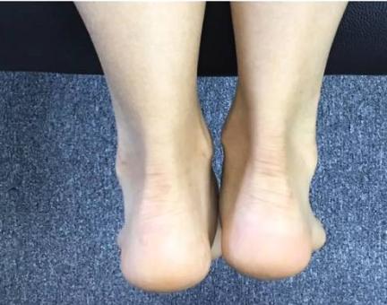 你有骨盆不正引起的长短腿吗？教你怎么矫正！（附视频）