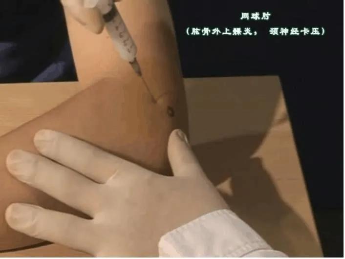 胳膊肘疼痛说是网球炎怎么治疗,网球肘两个胳膊都痛