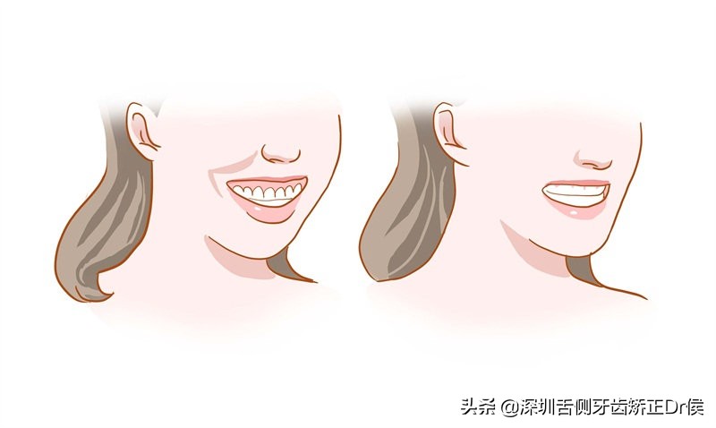 露龈笑原因,露龈笑矫正