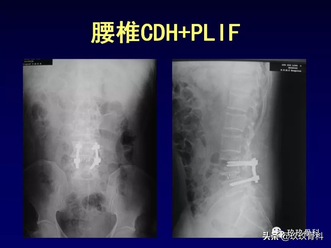 腰椎不稳最坏的结果,腰椎不稳的最佳治疗方法
