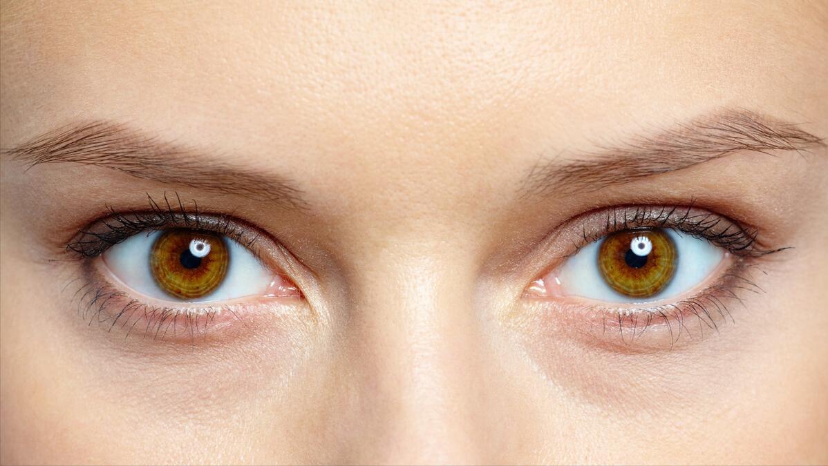 双眼皮刚刚做完和一个月后的对比,双眼皮做完太自然和没做一样