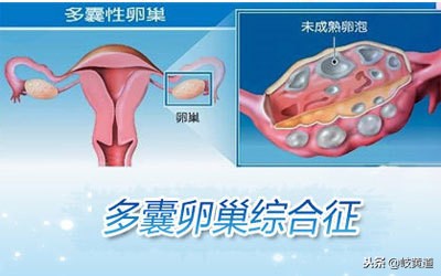 pcos多囊卵巢综合征的临床表现,多囊卵巢综合症如何诊断出来