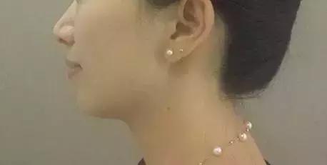 你知道什么是玻尿酸吗,如何快速了解玻尿酸品类