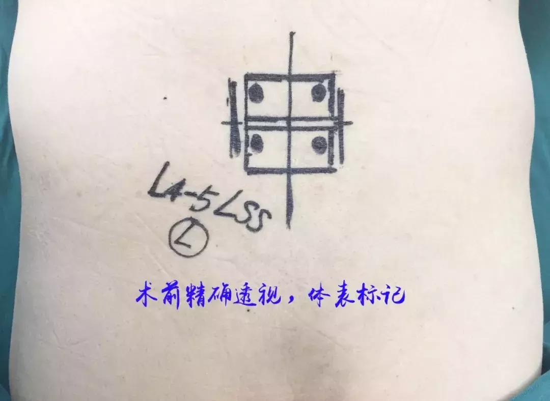 什么人适合微创手术治疗腰突,可视放射性治疗腰突效果怎么样