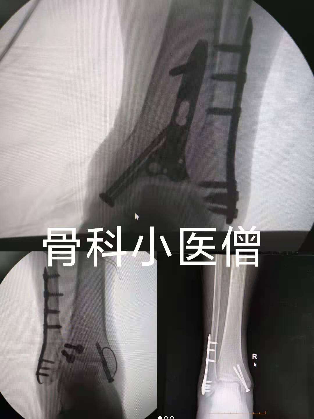 踝关节骨折恢复训练,踝关节骨折几级伤残