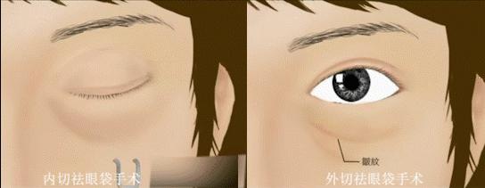 割眼袋和割双眼皮哪个风险大,男士眼袋手术内切有什么风险
