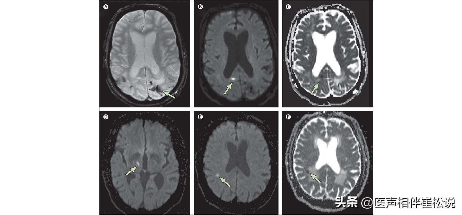 脑梗和腔梗是一回事儿吗,脑梗和腔梗是一回事吗