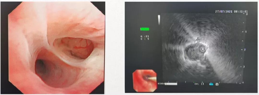 治疗后体温恢复,症状、影像仍进展,证据指向的感染竟只是迷障?