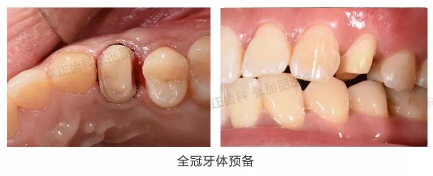 牙齿楔状缺损修复视频,牙齿缺损了可以选择哪些修复方式