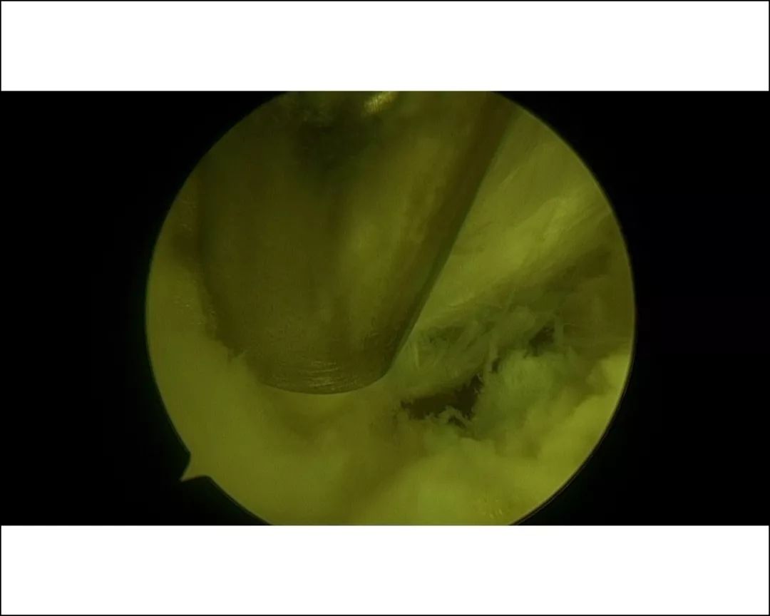 广州天河区中医院骨伤二科成功实施关节镜下跟骨骨刺摘除术